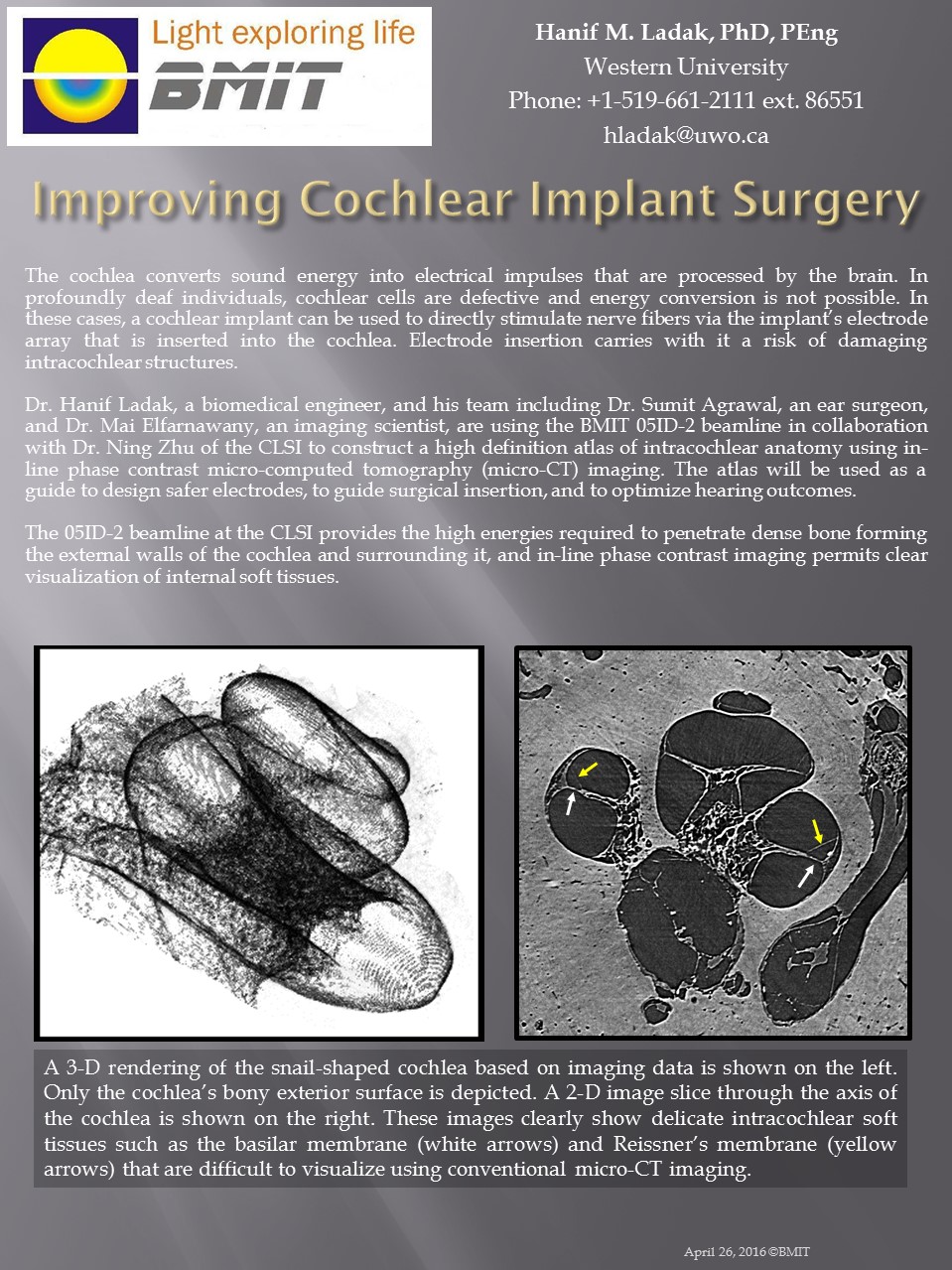 Improving Cochlear Implant Surgery Image